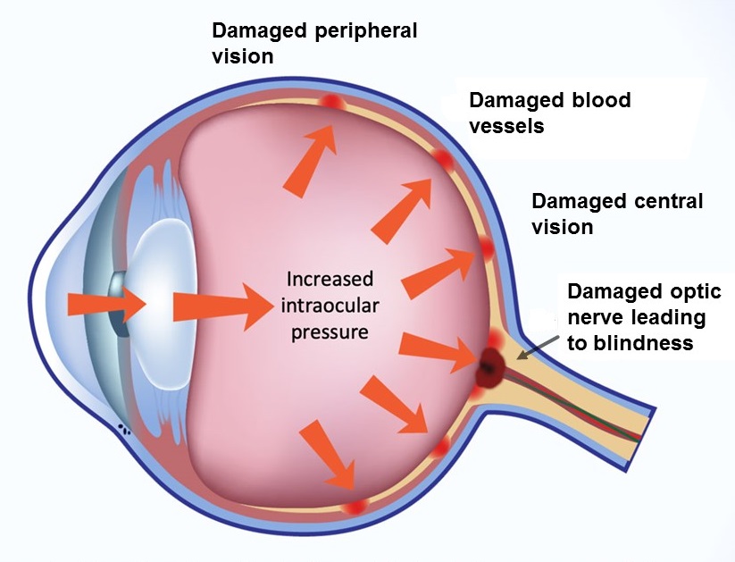 Effects of glaucoma on the eye.